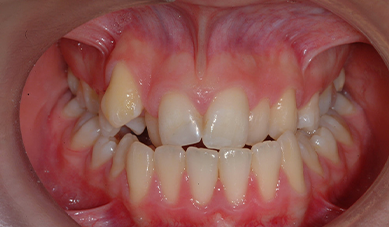 Metal braces Metal braces