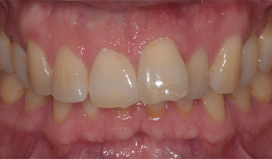 Invisalign Invisalign