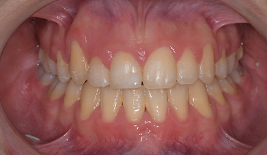 Metal braces Metal braces