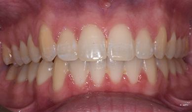 Ceramic-braces-After_2.png Ceramic-braces-After_2.png