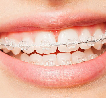 Ceramic braces