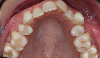 FIXED CERAMIC BRACES FIXED CERAMIC BRACES