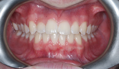 Fixed metal braces Fixed metal braces
