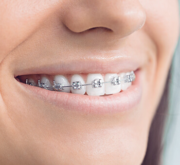 Metal braces