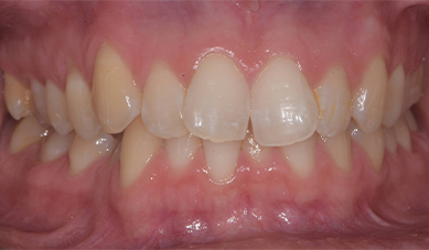 Ceramic-braces-After_2.png Ceramic-braces-After_2.png