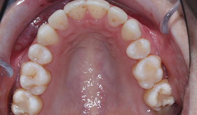 FIXED CERAMIC BRACES FIXED CERAMIC BRACES