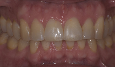 Invisalign Invisalign