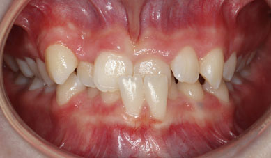Fixed metal braces Fixed metal braces
