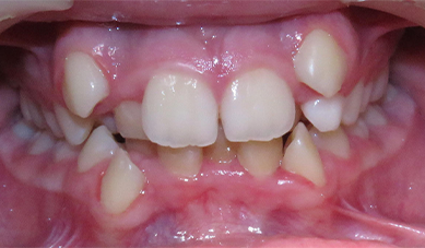 Stainless-Steel-Braces-After.png Stainless-Steel-Braces-After.png