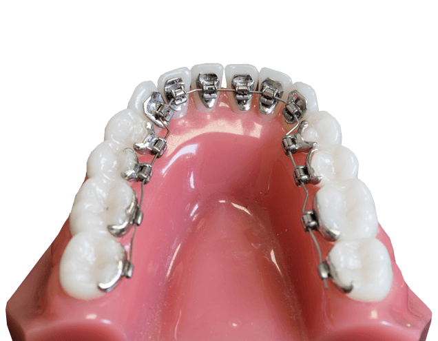What are lingual braces?